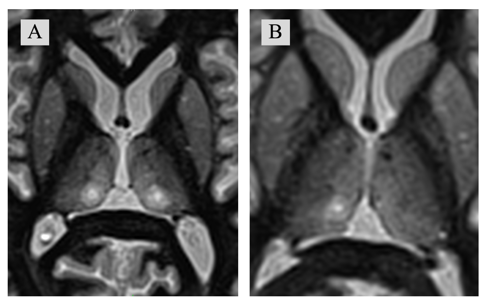 Рисунок 1: На послеоперационных снимках в аксиальной плоскости на уровне соответствующему D7 по стереотаксическому атласу Morel et. Al представлены А – Очаги воздействия после билатеральной CLT; B – Очаг деструкции после правосторонней CLT. (CLT: Центрально-латеральная таламотомия)